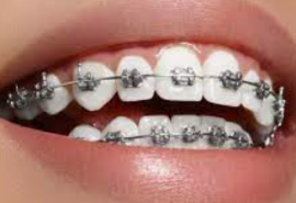 Top 10 Địa chỉ niềng răng uy tín nhất Đà Nẵng